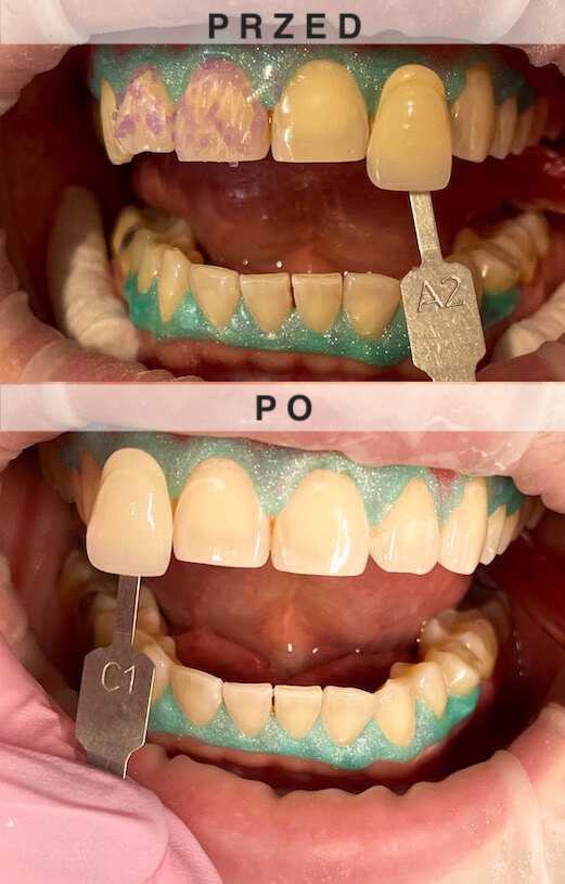 wybielanie laserowe